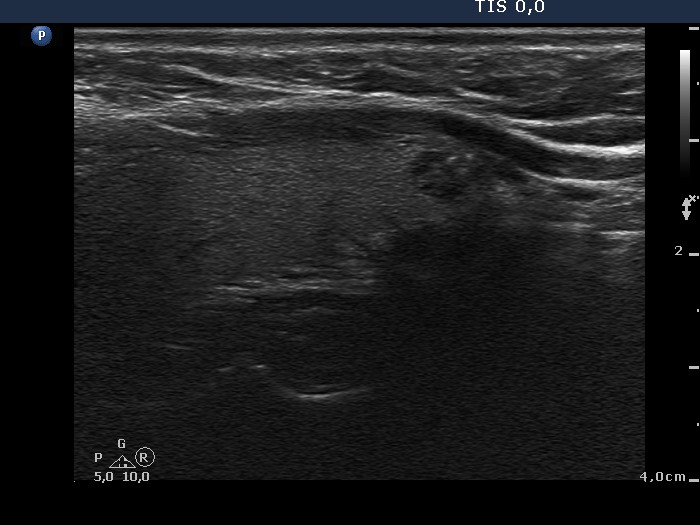 Right lobe, longitudinal scan