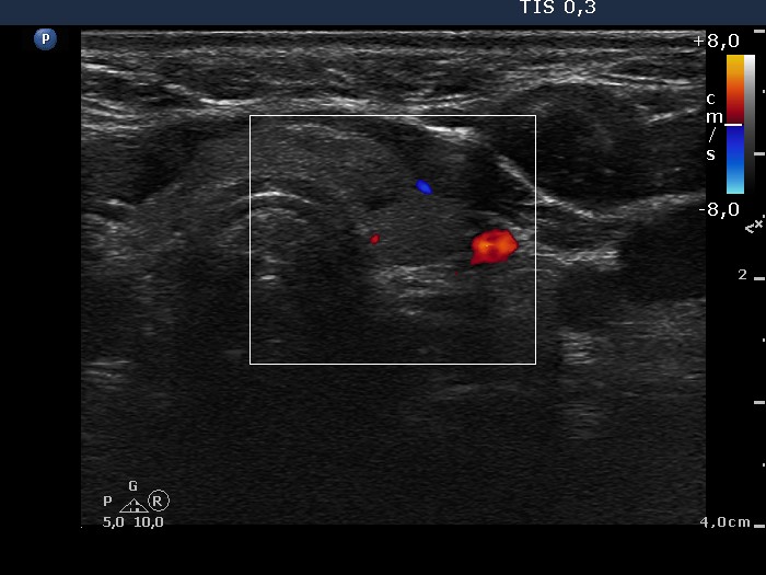 Right lobe, longitudinal scan