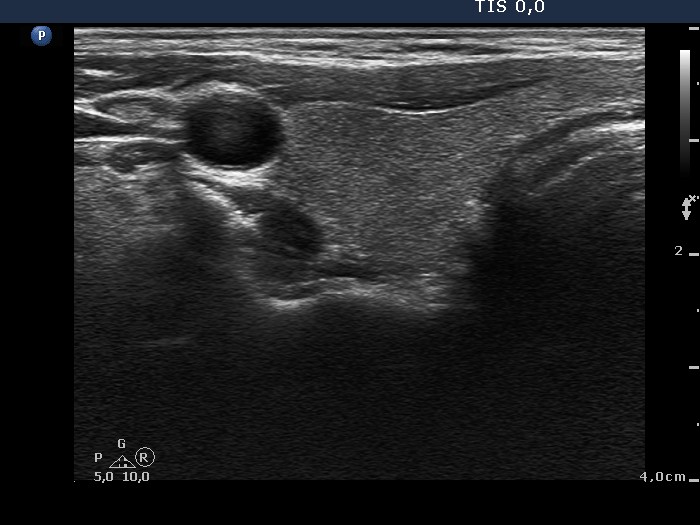 Right lobe, horizontal view
