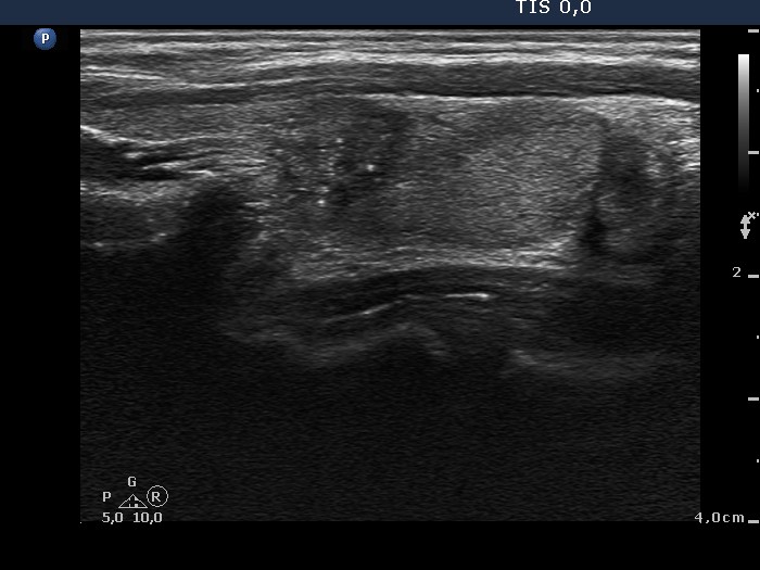 Right lobe, longitudinal scan