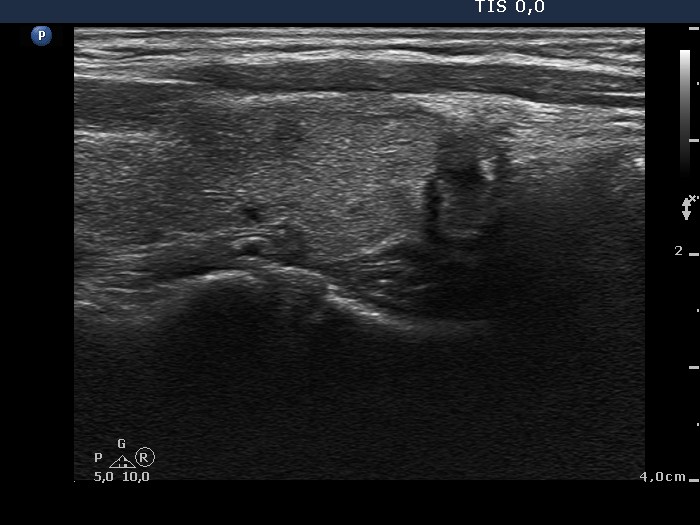 Right lobe, longitudinal scan