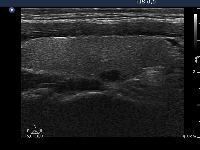 Right lobe, longitudinal scan
