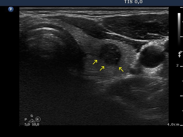 Right lobe, longitudinal scan