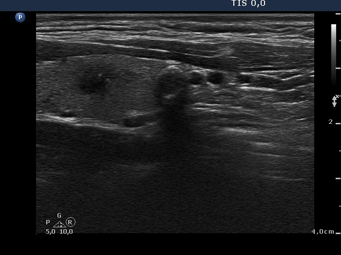 Right lobe, longitudinal scan