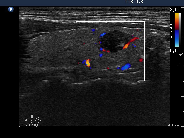 Right lobe, longitudinal scan