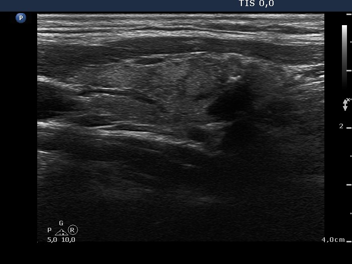 Right lobe, longitudinal scan