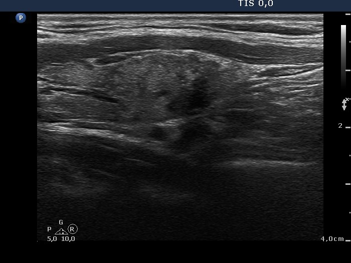 Right lobe, longitudinal scan