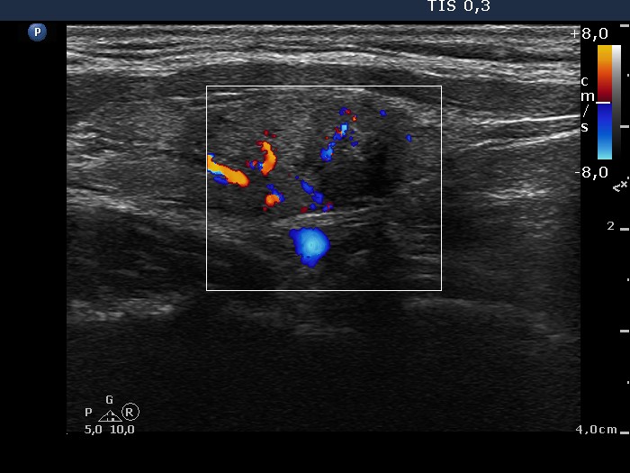 Right lobe, longitudinal scan