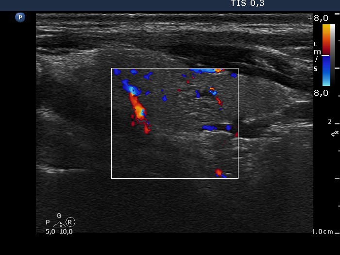 Right lobe, longitudinal scan