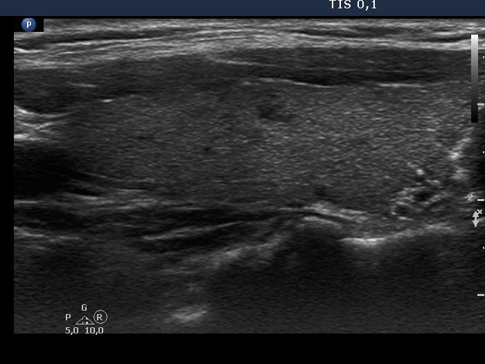 Right lobe, longitudinal scan