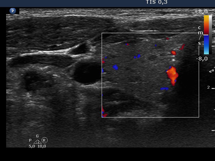 Right lobe, longitudinal scan
