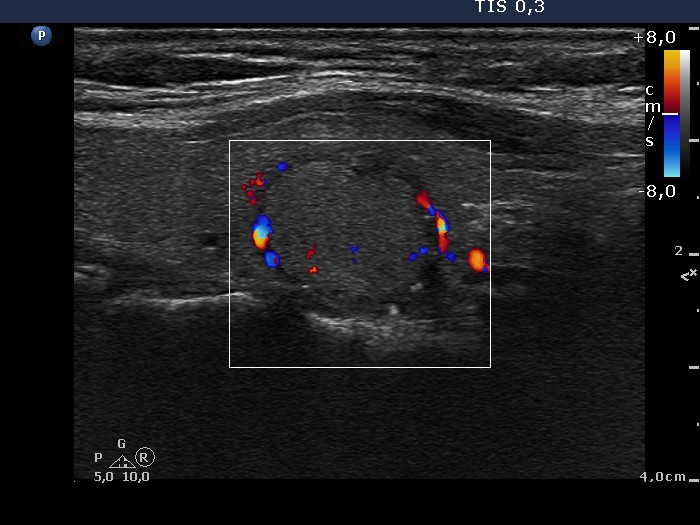 Right lobe, longitudinal scan