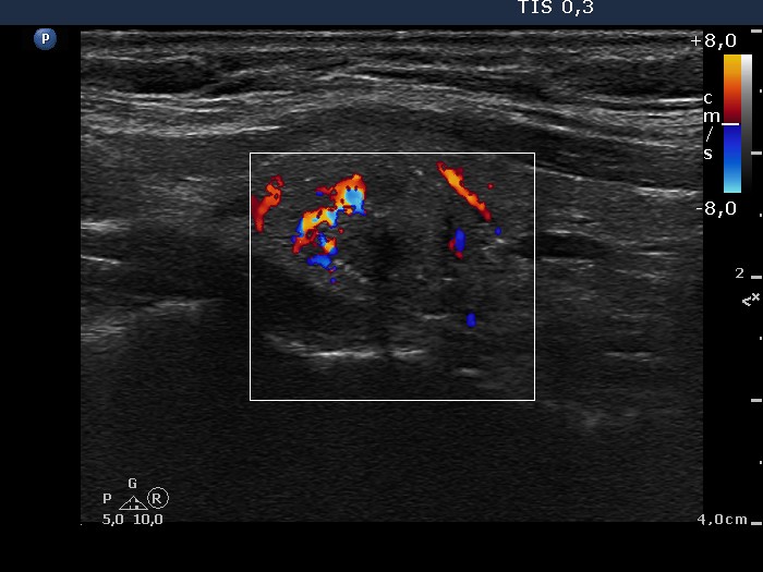 Right lobe, longitudinal scan