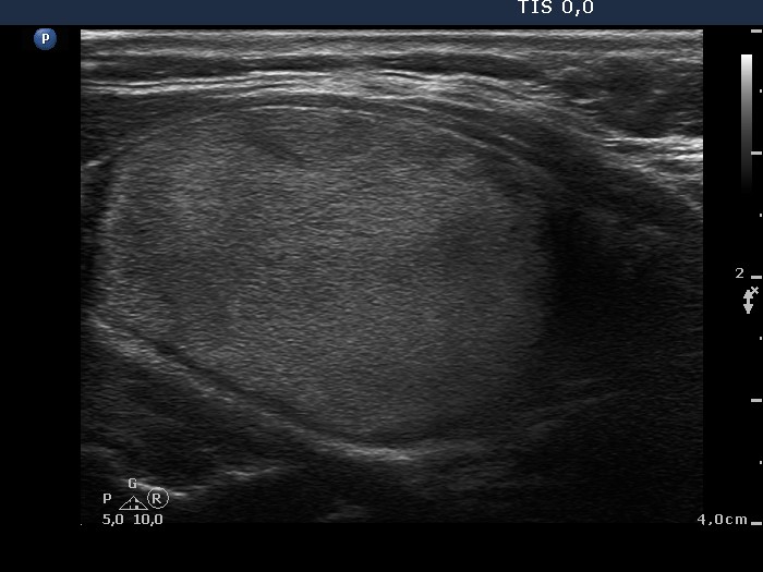 Right lobe, longitudinal scan