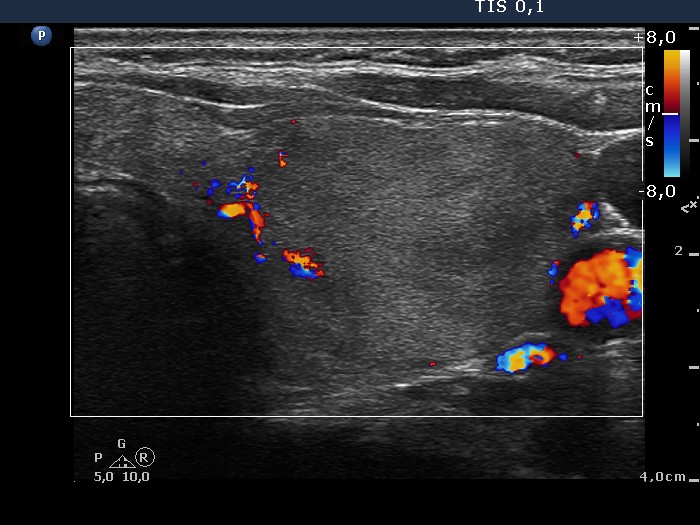 Right lobe, longitudinal scan