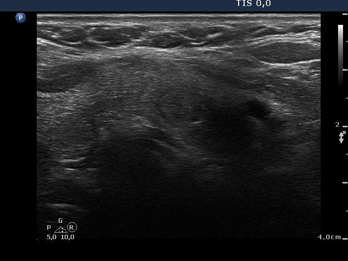 Right lobe, longitudinal scan