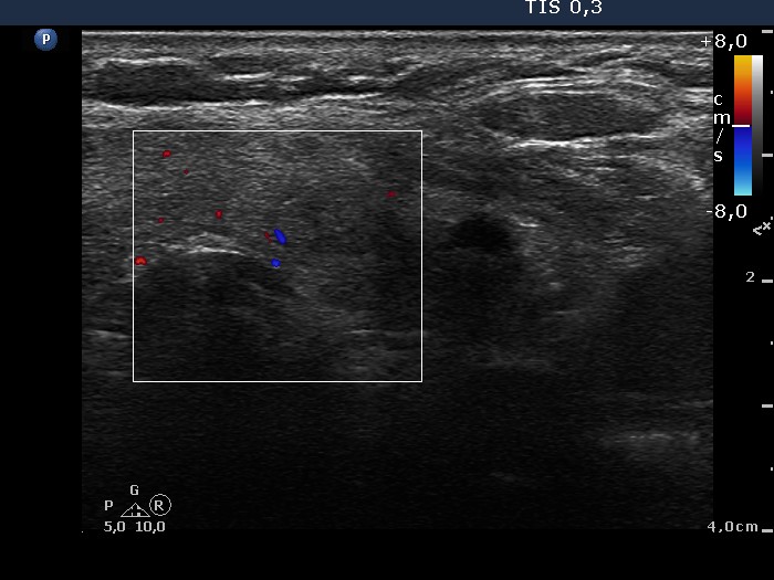 Right lobe, longitudinal scan