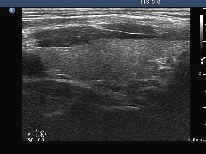 Right lobe, longitudinal scan