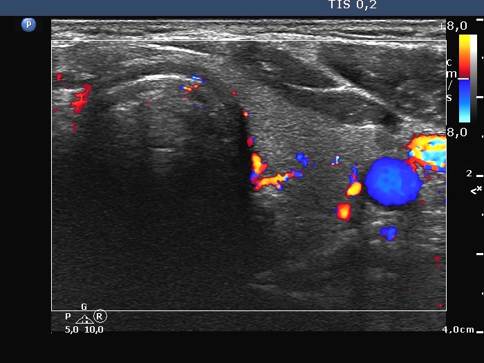 Right lobe, longitudinal scan
