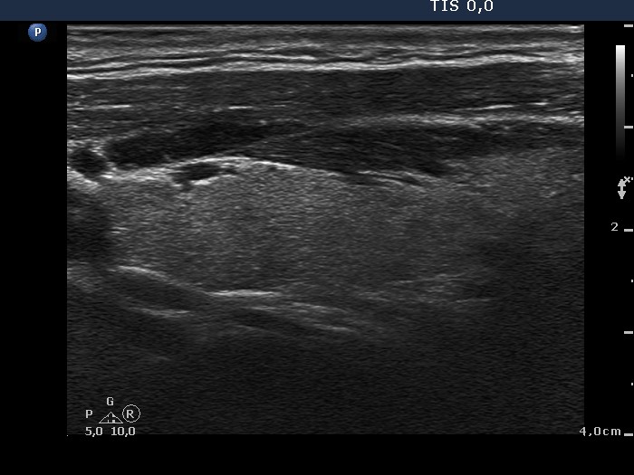 Right lobe, longitudinal scan