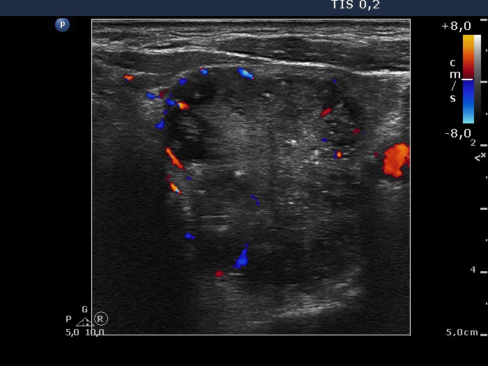 Right lobe, longitudinal scan