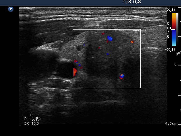 Right lobe, longitudinal scan