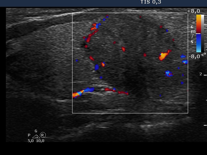 Right lobe, longitudinal scan