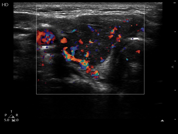 Right lobe, longitudinal scan