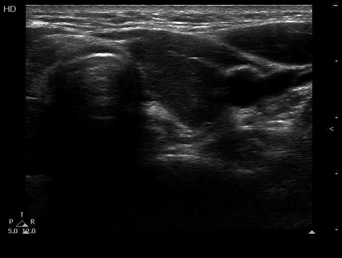 Right lobe, longitudinal scan