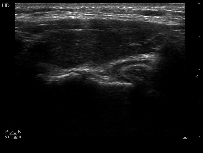 Right lobe, longitudinal scan