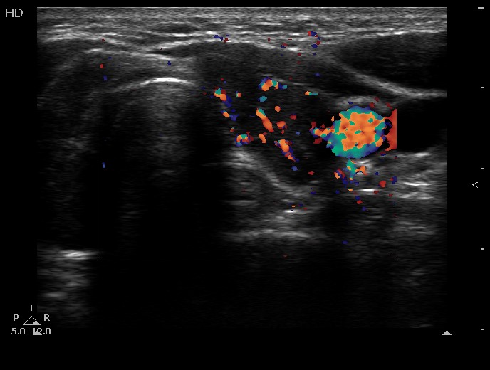 Right lobe, longitudinal scan