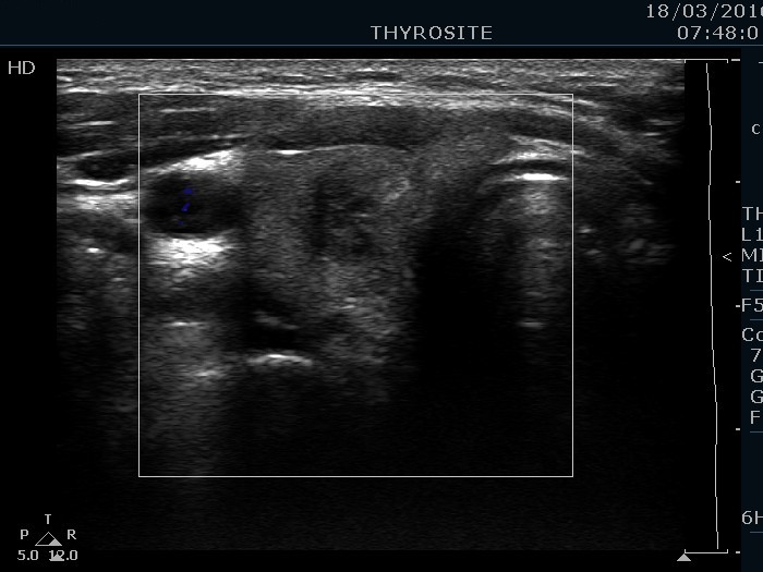 Right lobe, longitudinal scan