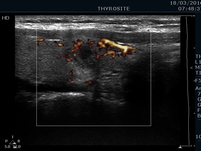 Right lobe, longitudinal scan