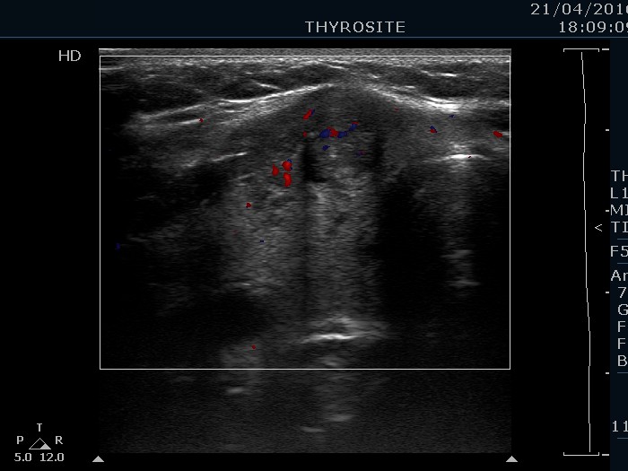 Right lobe, longitudinal scan
