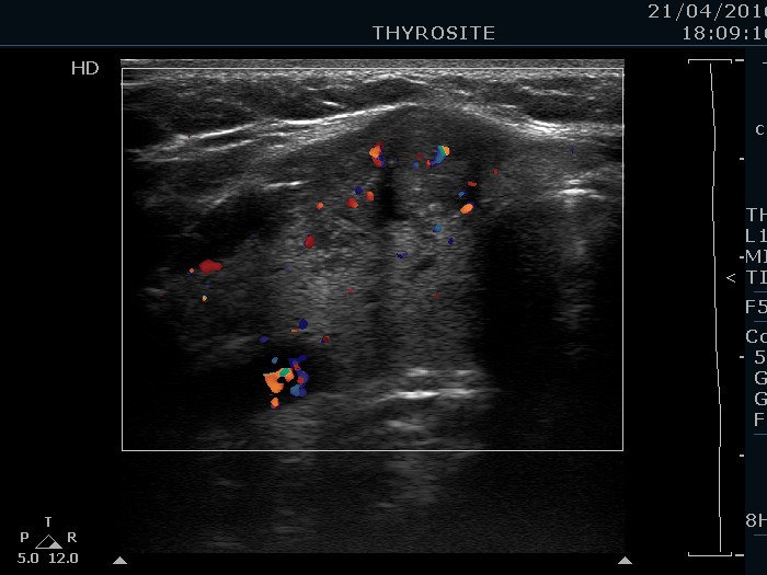 Right lobe, longitudinal scan