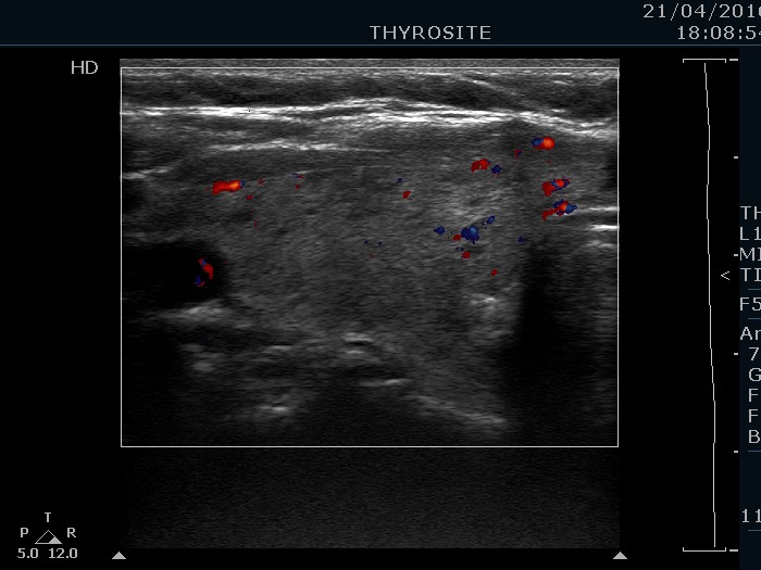 Right lobe, longitudinal scan