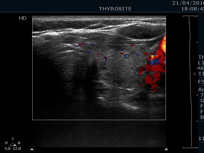 Right lobe, longitudinal scan