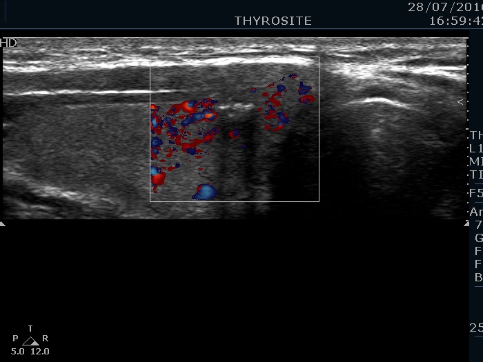 Right lobe, longitudinal scan