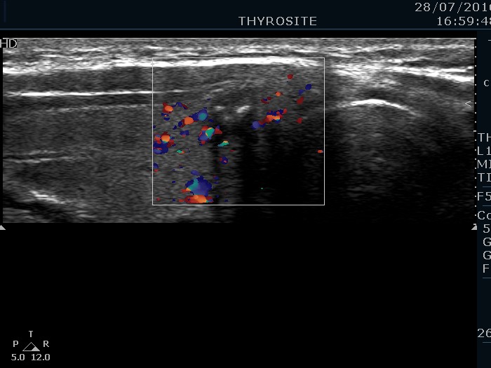 Right lobe, longitudinal scan