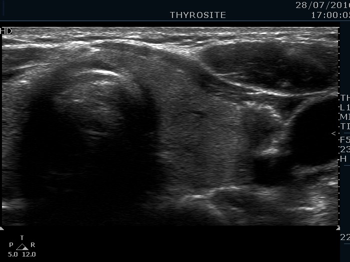 Right lobe, longitudinal scan