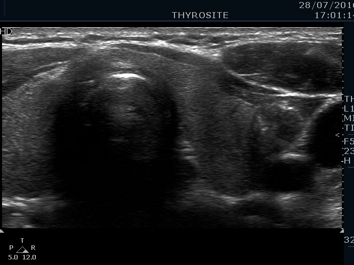 Right lobe, longitudinal scan