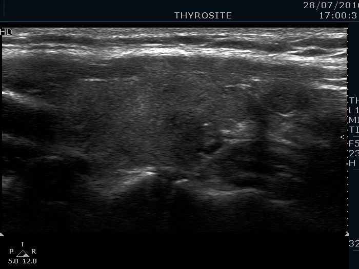 Right lobe, longitudinal scan