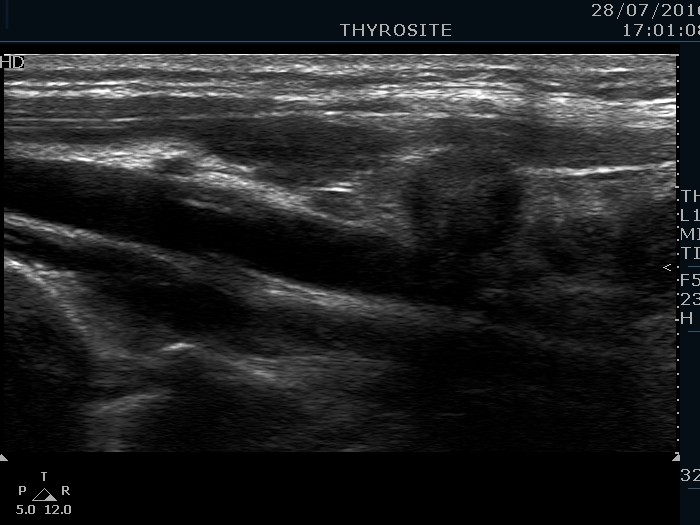 Right lobe, longitudinal scan