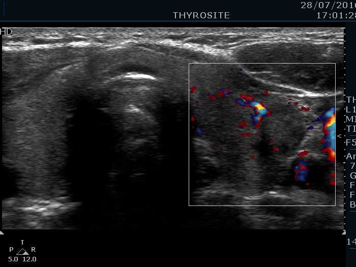 Right lobe, longitudinal scan