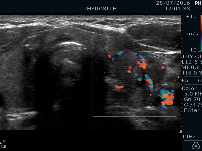 Right lobe, longitudinal scan