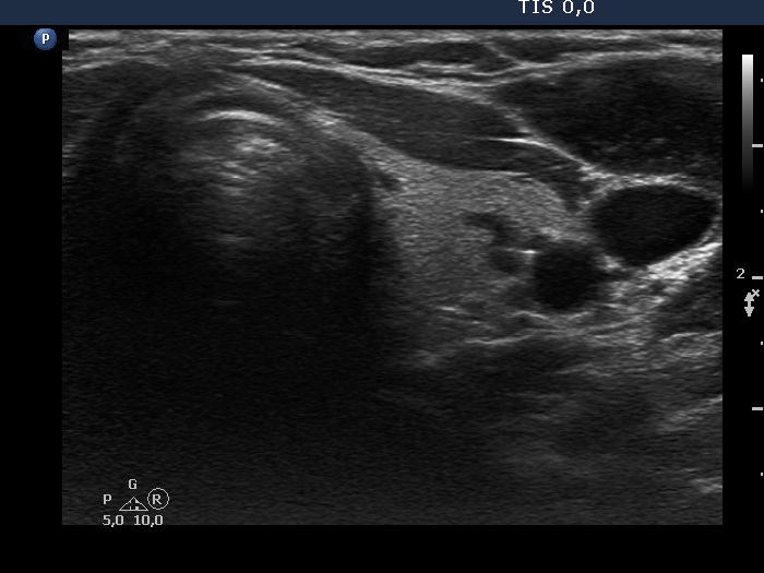 Right lobe, longitudinal scan
