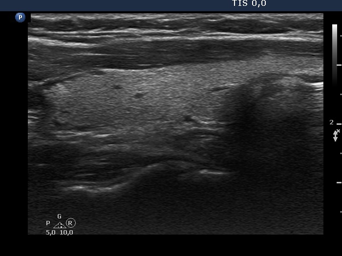 Right lobe, longitudinal scan