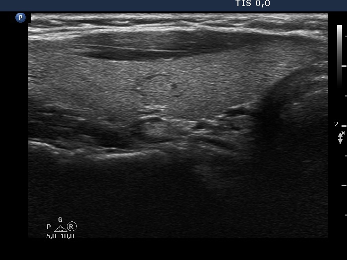 Right lobe, longitudinal scan