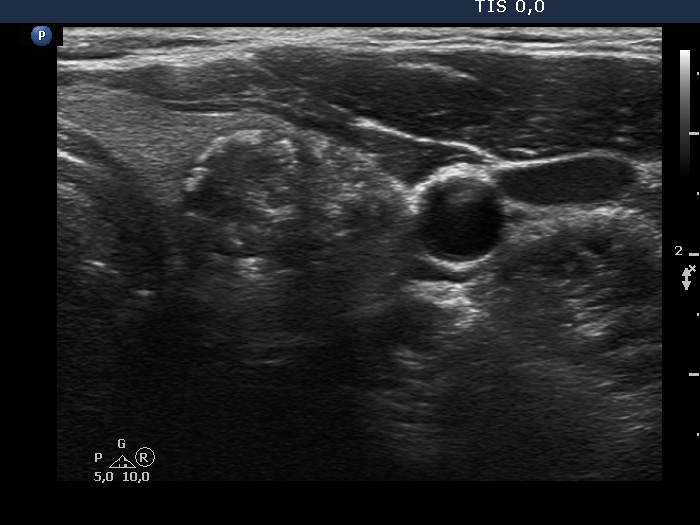 Right lobe, longitudinal scan