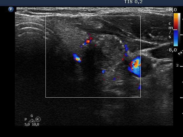 Right lobe, longitudinal scan